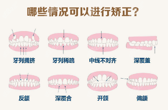 成都君臣口腔种植牙价格