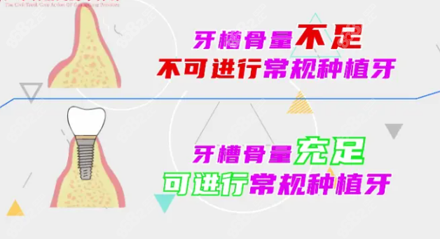 穿颧穿翼种植手术适应症