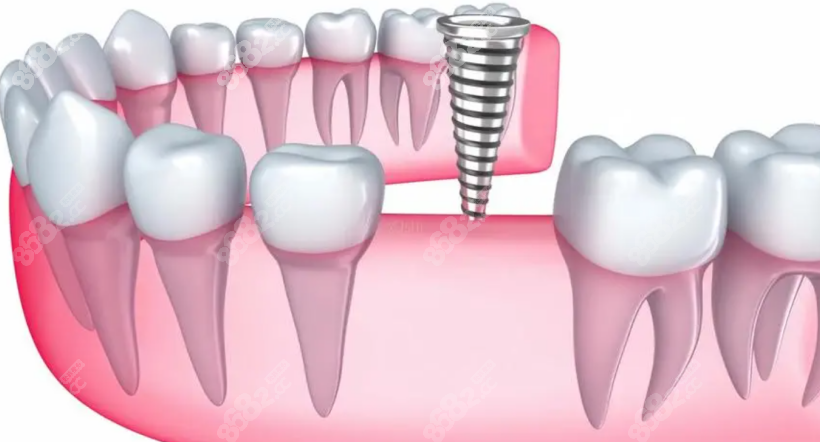 广州广大口腔医院2023年种植牙价格