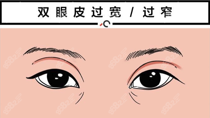 重庆双眼皮失败修复医生是谁www.8682.cc