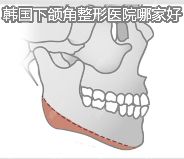 韩国下颌角整形医院哪家好