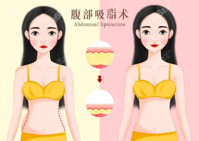 腹壁整形和腰腹环吸哪个好