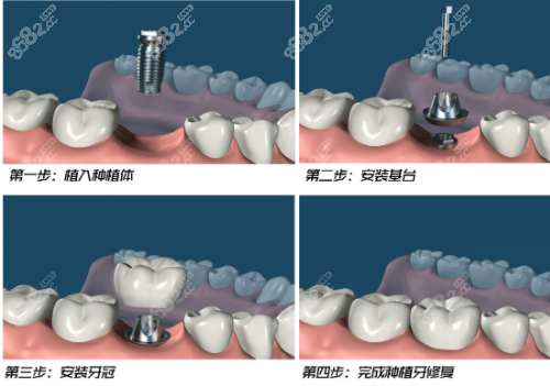 种植牙的顺序