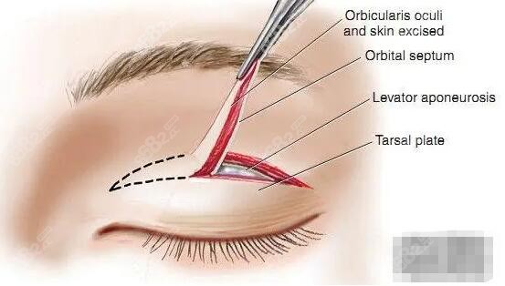 杭州艺星高士乾双眼皮修复价格是多少钱