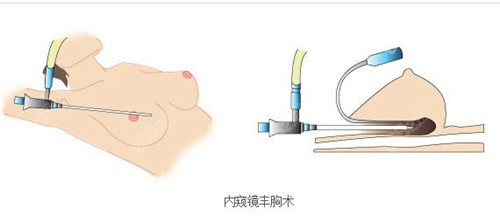 赵亚均隆胸技术好吗