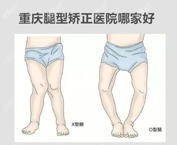 重庆腿型矫正医院哪家好