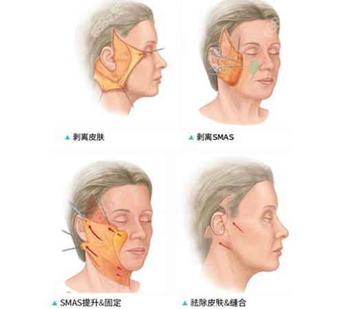 面部提升手术卡通图