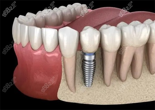 单颗种植牙侧面展示图