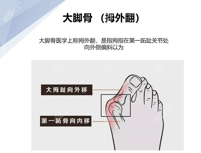 苏敬达做大脚骨手术技术水平咋样