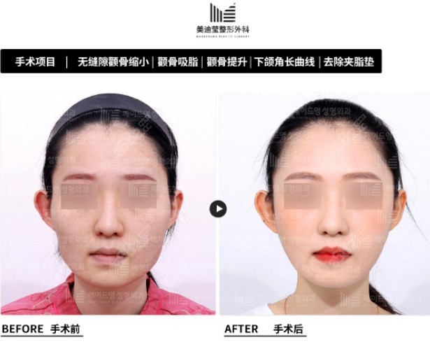 韩国美迪莹轮廓实例www.8682.cc