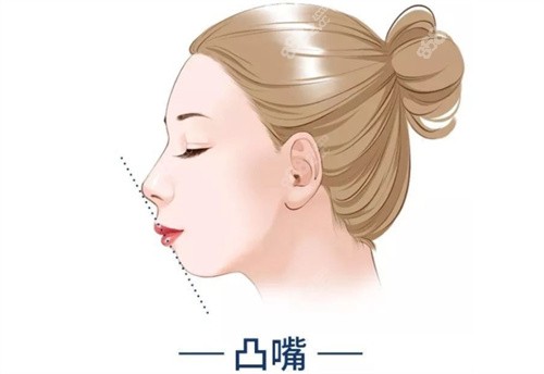 人中缩短能改善凸嘴