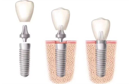 种植牙手术流程图