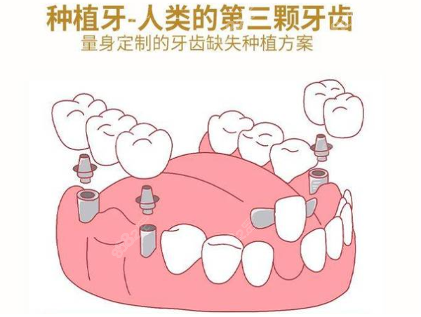 杭州下城口腔医院种植牙多少钱一颗