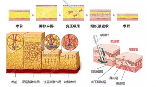 赵亚均吸脂怎么样