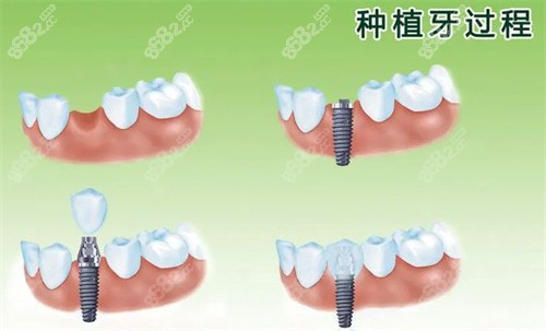 種植牙過程