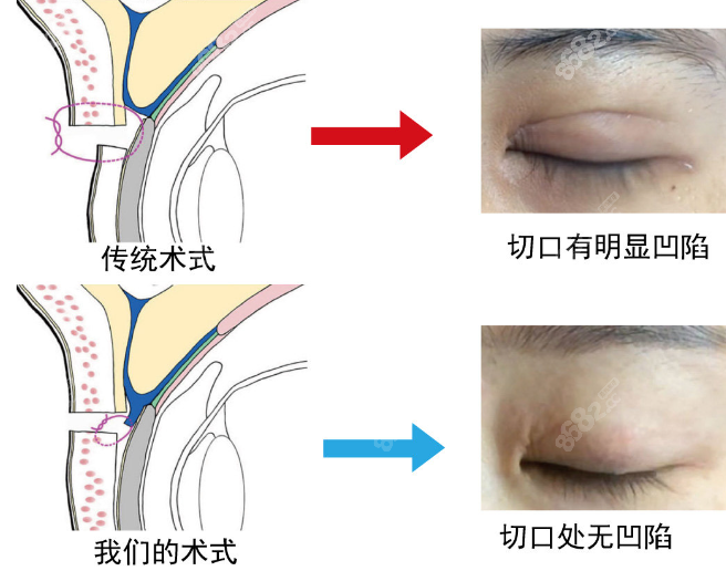 佀同帅双眼皮修复手术图示