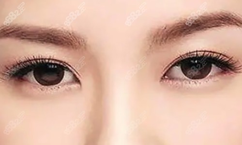 6D睑緣切开明星眼技术