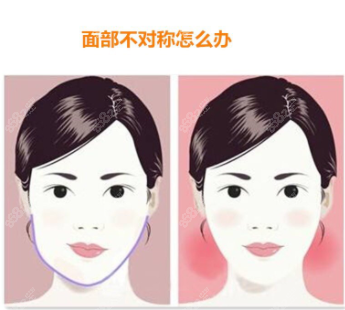 顴骨不對(duì)稱(chēng)需要顴骨內(nèi)推