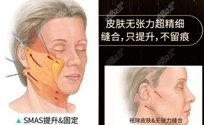 黄广香医生小切口拉皮疤痕小