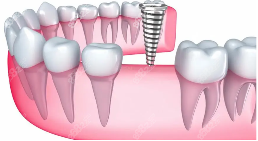 深圳愛康健口腔醫(yī)院種植牙 深圳愛康健口腔醫(yī)院種植牙