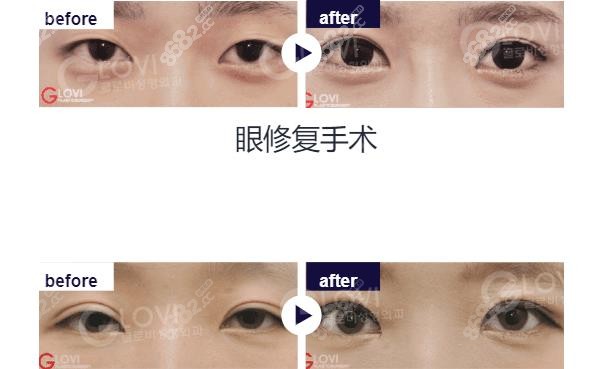 该院眼睛手术前后对比