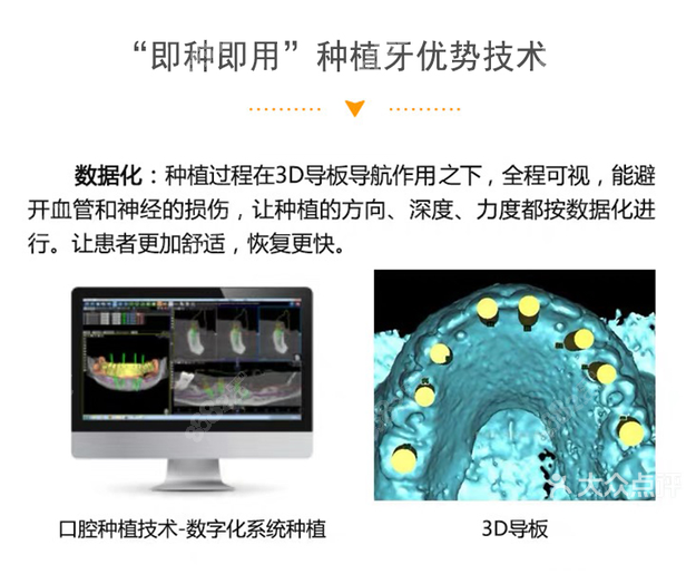 种植牙导板是干什么用的