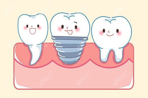 新桥口腔种植牙价格