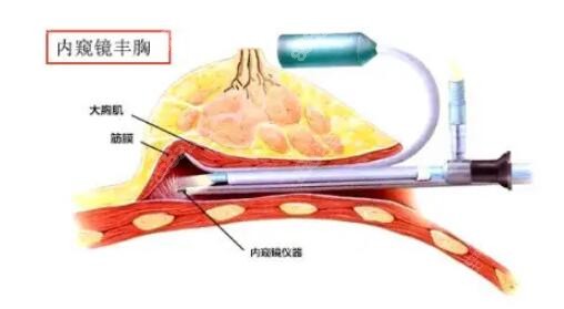 重庆华美做IMF丰胸2.0的价格多少钱