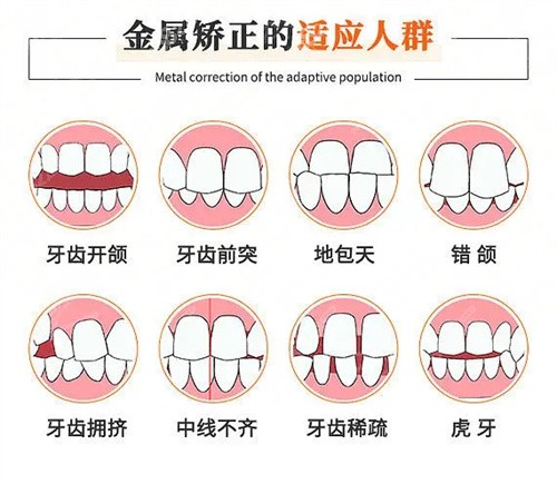 金属托槽矫正术