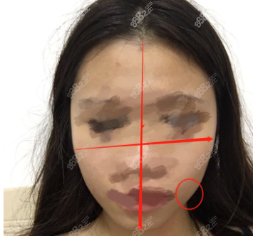 顴骨不對(duì)稱(chēng)的表現(xiàn)
