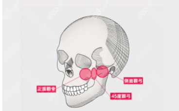 顴骨不對(duì)稱(chēng)的手術(shù)方式