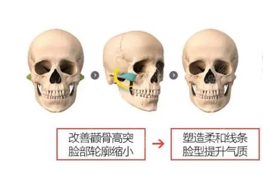 何晋龙颧骨内推做得好