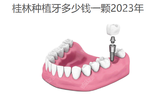 桂林种植牙多少钱一颗2023年