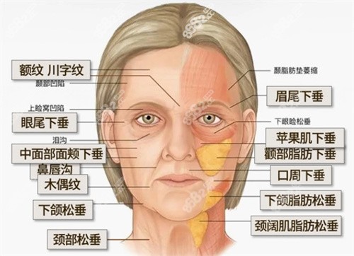 穆宝安面部提升价格贵吗？