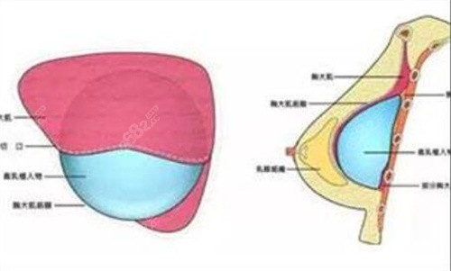 李子鹏内窥镜隆胸