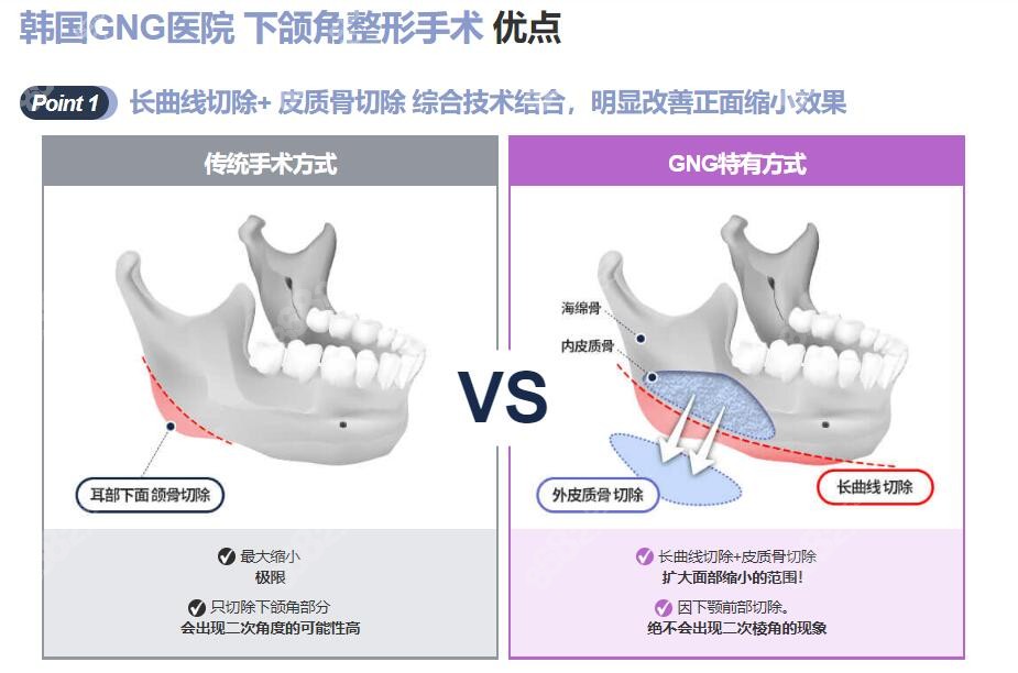 韩国GNG下颌角整形