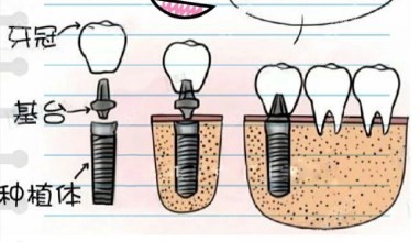 种植牙结构