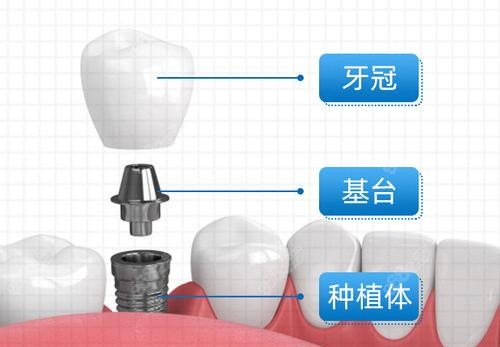 国内连锁牙科种植牙收费标准