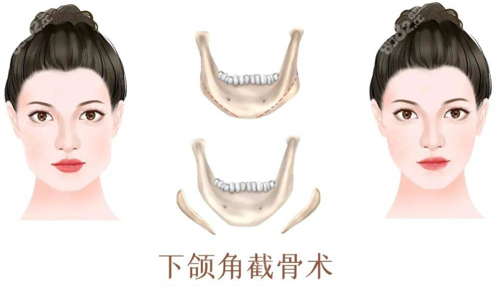 下颌角截骨手术图示