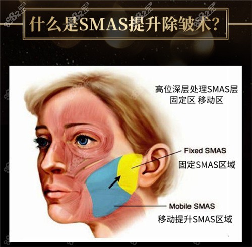 SMAS提升层次展示