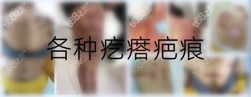 贵阳华医疤痕科专治疙瘩增生疤痕