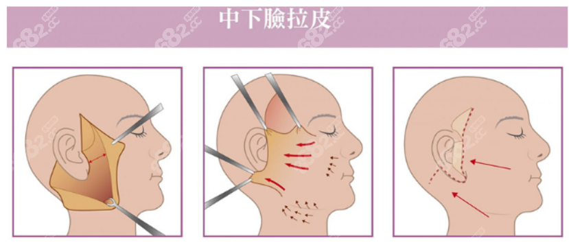 广州中家医家庭医生拉皮手术价格