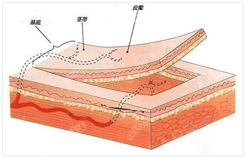 疤痕治疗中的皮肤结构图