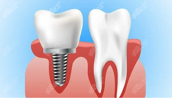 杭州种植牙做得好的医院是谁