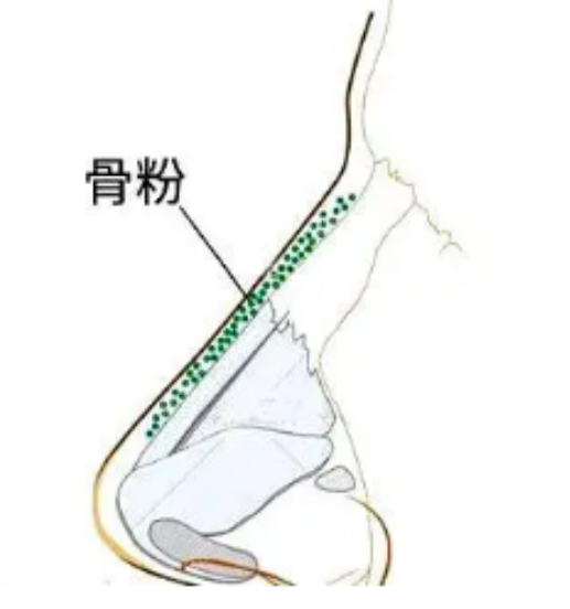 齐云香医生取出骨粉怎么样