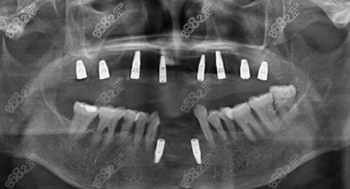 多颗牙种植ct照片