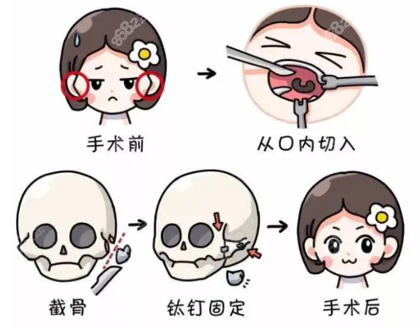 韩国整形名医郑志雄医生颧骨内推优势