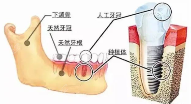 中诺口腔种植牙集采费用多少钱一颗