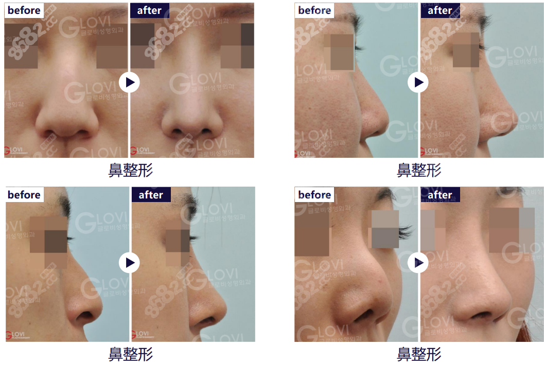 韩国歌柔飞整形医院鲁峰一医生做鼻子图片