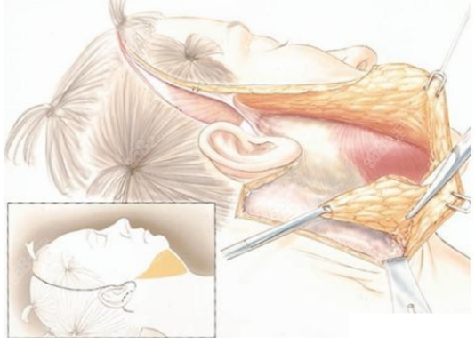 大拉皮手术过程图8682.cc